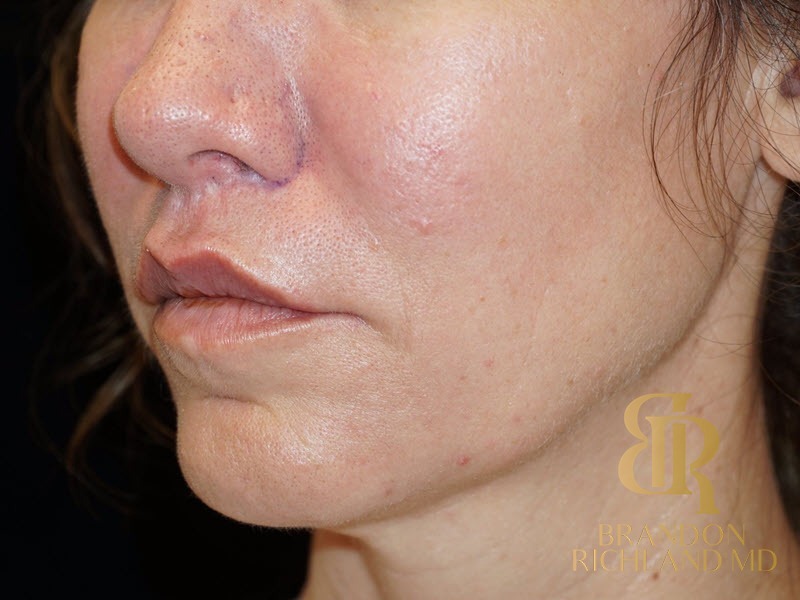 Lip Lift Before, Patient 01, view 5 — Dr. Brandon Richland, Newport Beach