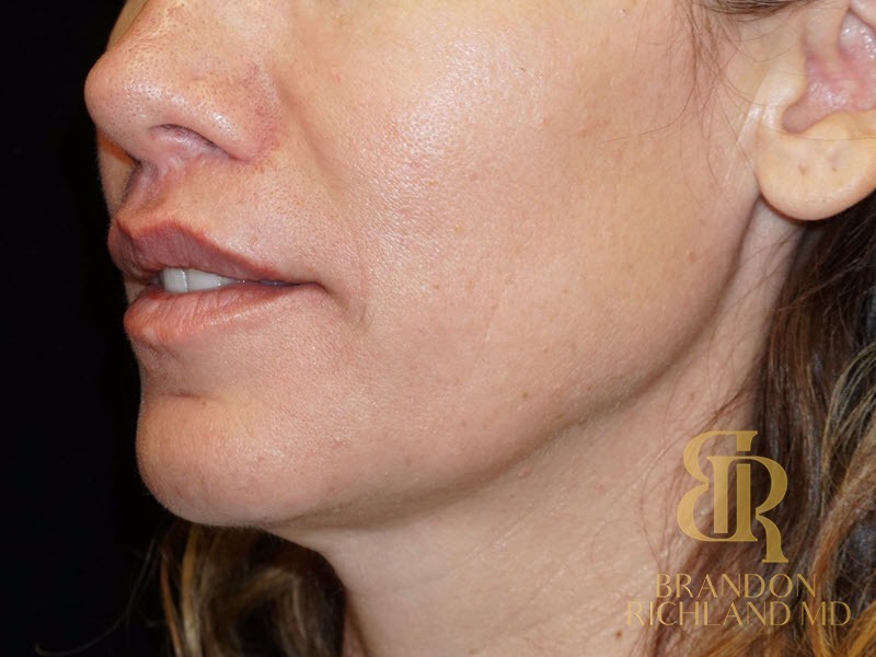 Lip Lift After, Patient 01, view 5 — Dr. Brandon Richland, Newport Beach
