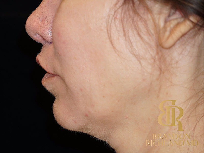 Lip Lift Before, Patient 01, view 6 — Dr. Brandon Richland, Newport Beach