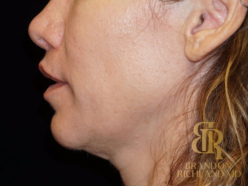 Lip Lift After, Patient 01, view 6 — Dr. Brandon Richland, Newport Beach
