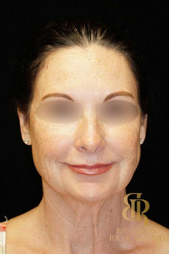 Neck Lift Before, Patient 01, view 1 — Dr. Brandon Richland, Newport Beach