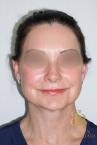 Neck Lift before and after, Patient 01 — Dr. Brandon Richland, Newport Beach