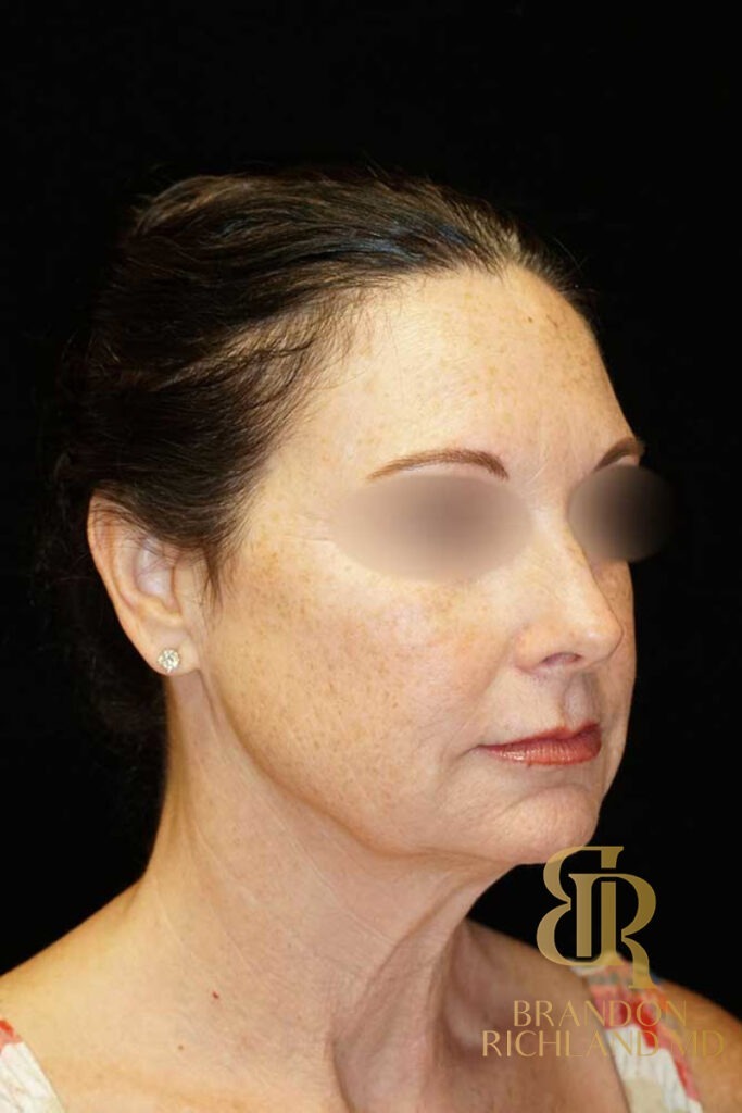 Neck Lift Before, Patient 01, view 2 — Dr. Brandon Richland, Newport Beach