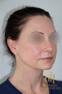 Neck Lift before and after, Patient 01 — Dr. Brandon Richland, Newport Beach