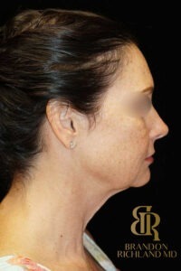 Neck Lift before and after, Patient 01 — Dr. Brandon Richland, Newport Beach