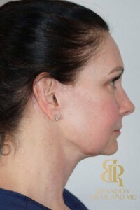 Neck Lift before and after, Patient 01 — Dr. Brandon Richland, Newport Beach
