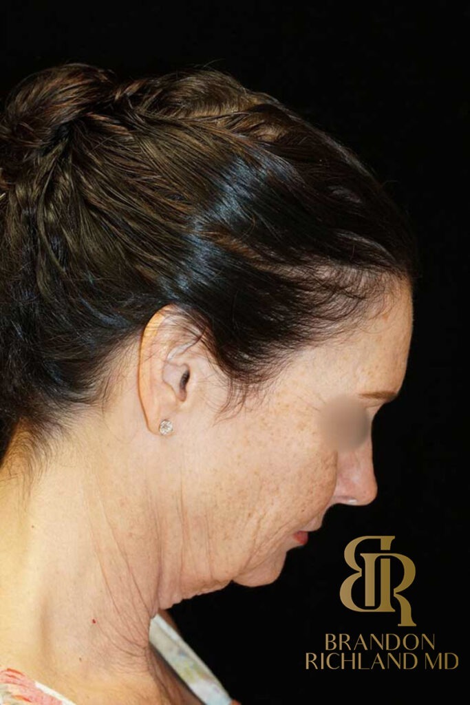 Neck Lift Before, Patient 01, view 4 — Dr. Brandon Richland, Newport Beach