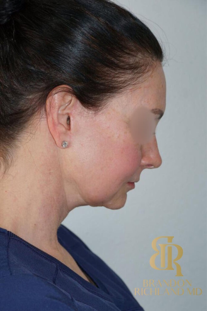 Neck Lift After, Patient 01, view 4 — Dr. Brandon Richland, Newport Beach