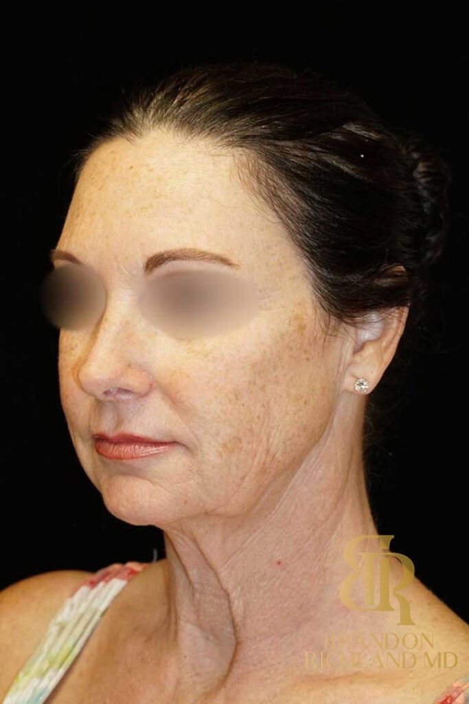 Neck Lift Before, Patient 01, view 5 — Dr. Brandon Richland, Newport Beach