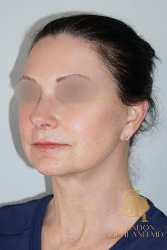 Neck Lift After, Patient 01, view 5 — Dr. Brandon Richland, Newport Beach
