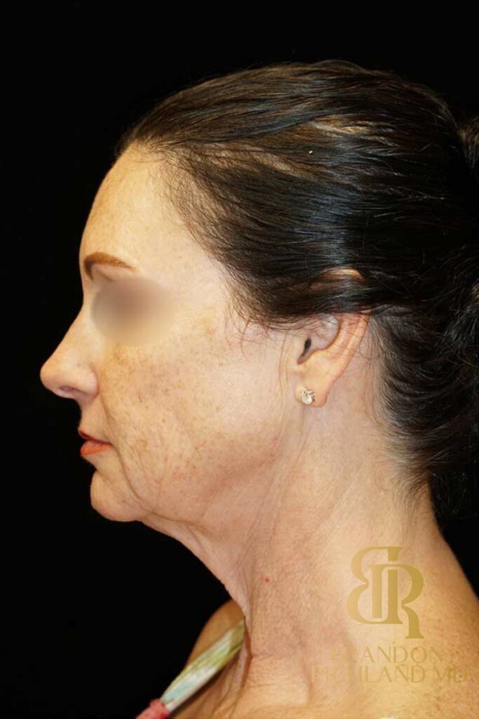 Neck Lift Before, Patient 01, view 6 — Dr. Brandon Richland, Newport Beach
