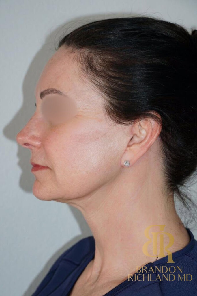 Neck Lift After, Patient 01, view 6 — Dr. Brandon Richland, Newport Beach