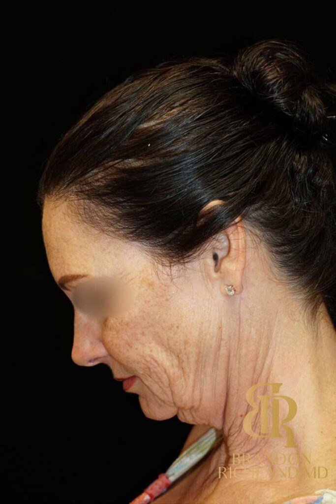 Neck Lift Before, Patient 01, view 7 — Dr. Brandon Richland, Newport Beach
