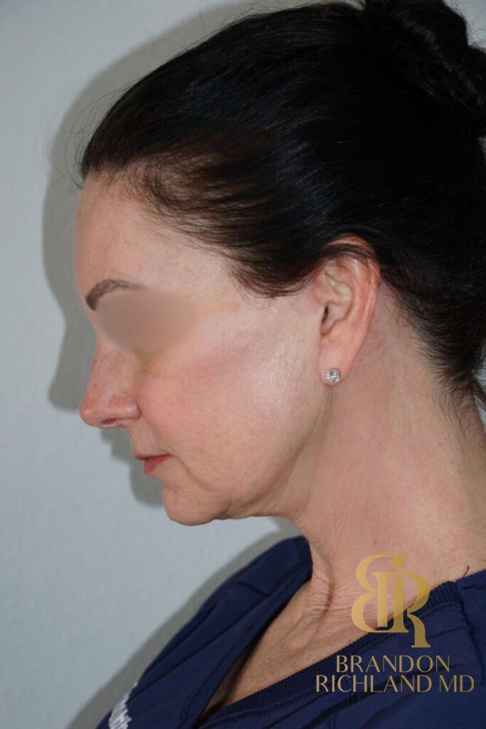 Neck Lift After, Patient 01, view 7 — Dr. Brandon Richland, Newport Beach
