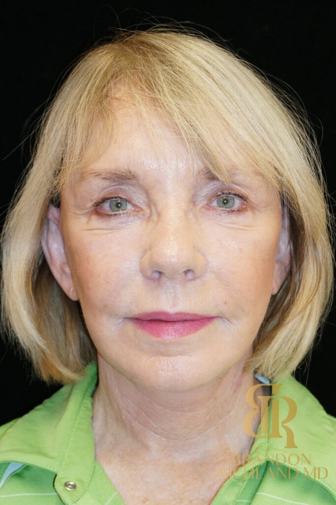 Neck Lift After, Patient 02, view 1 — Dr. Brandon Richland, Newport Beach