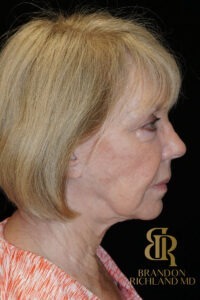 Neck Lift before and after, Patient 02 — Dr. Brandon Richland, Newport Beach