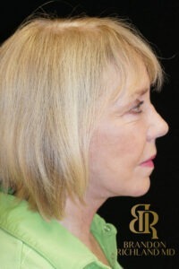 Neck Lift before and after, Patient 02 — Dr. Brandon Richland, Newport Beach