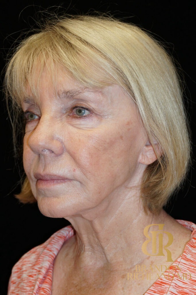 Neck Lift Before, Patient 02, view 5 — Dr. Brandon Richland, Newport Beach