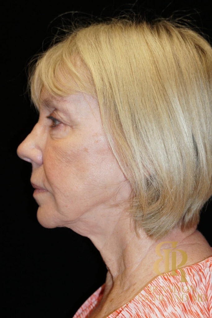 Neck Lift Before, Patient 02, view 6 — Dr. Brandon Richland, Newport Beach