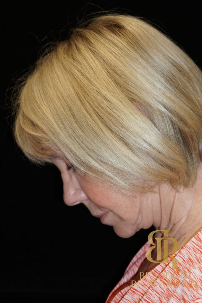 Neck Lift Before, Patient 02, view 7 — Dr. Brandon Richland, Newport Beach