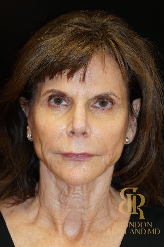 Neck Lift Before, Patient 03, view 1 — Dr. Brandon Richland, Newport Beach