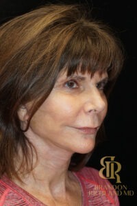 Neck Lift before and after, Patient 03 — Dr. Brandon Richland, Newport Beach