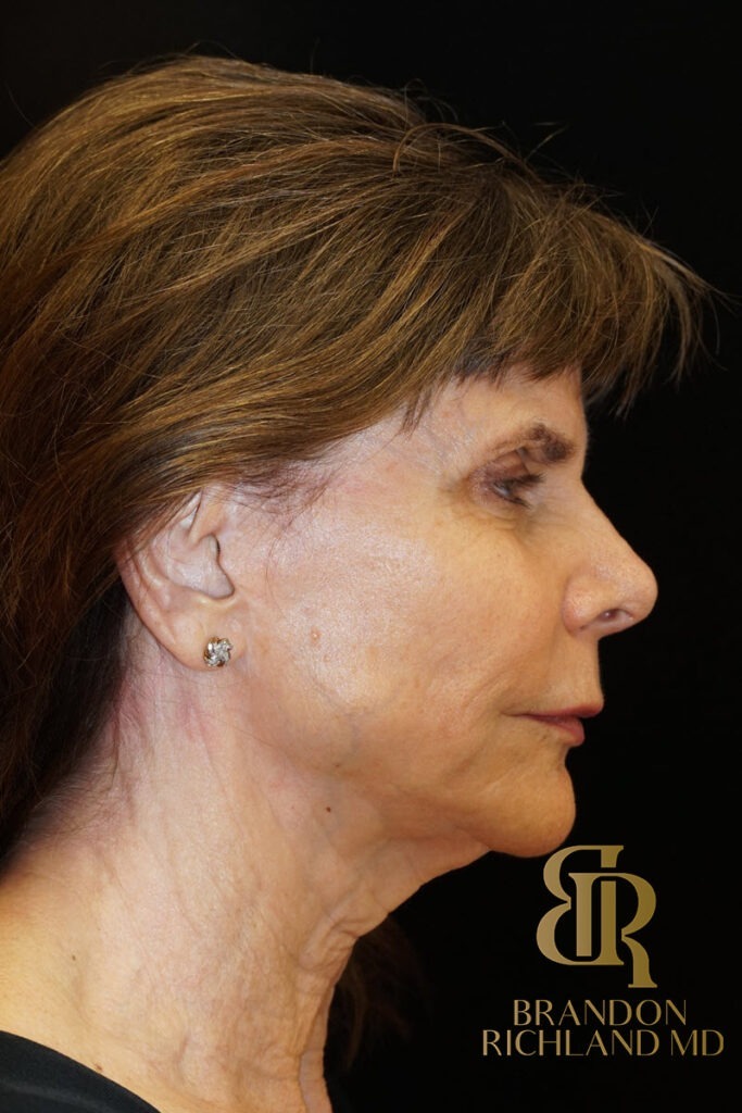 Neck Lift Before, Patient 03, view 3 — Dr. Brandon Richland, Newport Beach