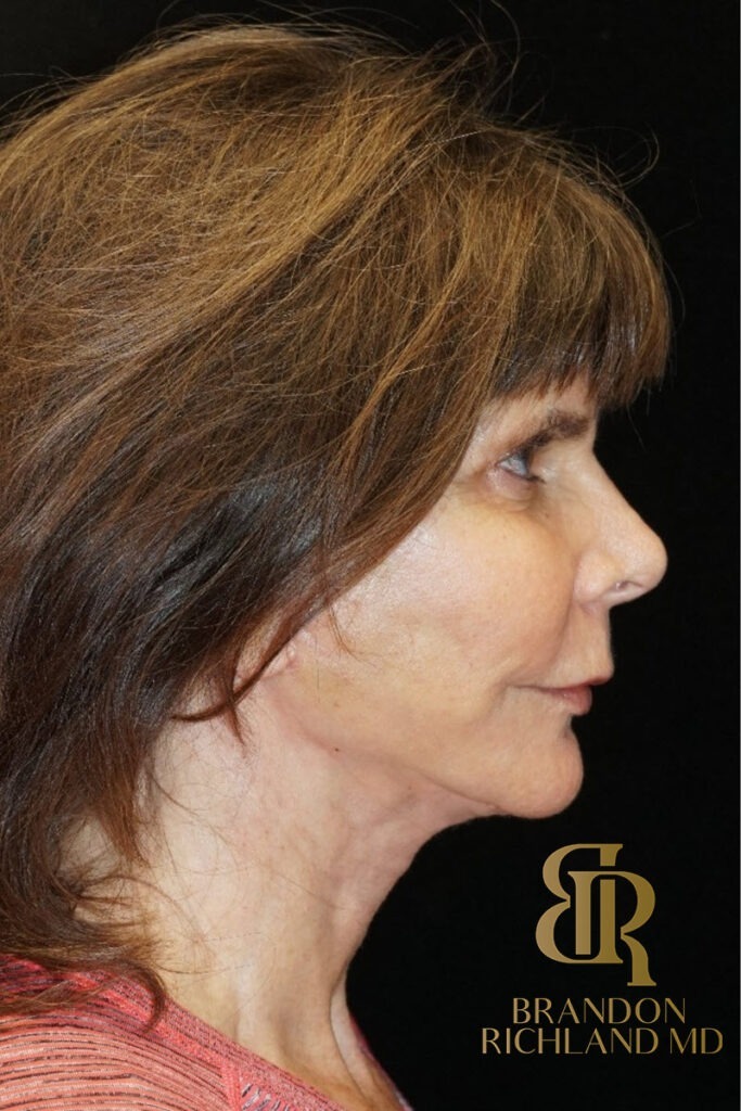 Neck Lift After, Patient 03, view 3 — Dr. Brandon Richland, Newport Beach