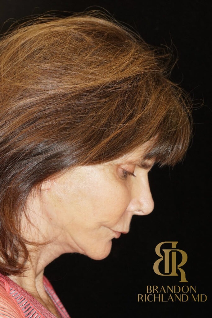 Neck Lift After, Patient 03, view 4 — Dr. Brandon Richland, Newport Beach