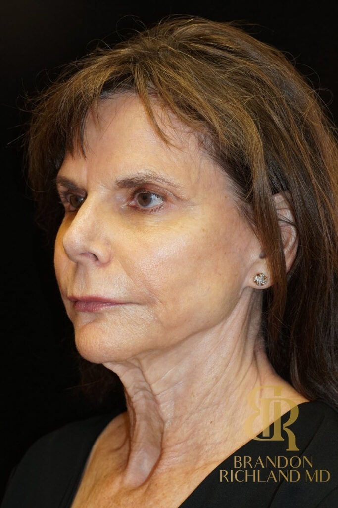 Neck Lift Before, Patient 03, view 5 — Dr. Brandon Richland, Newport Beach