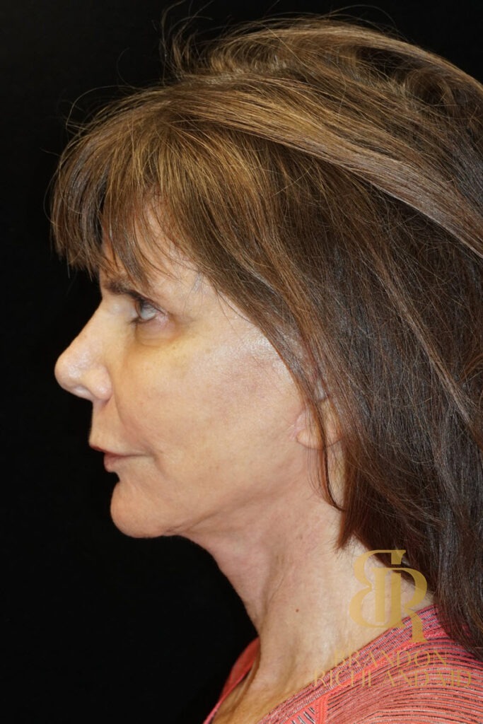 Neck Lift After, Patient 03, view 6 — Dr. Brandon Richland, Newport Beach