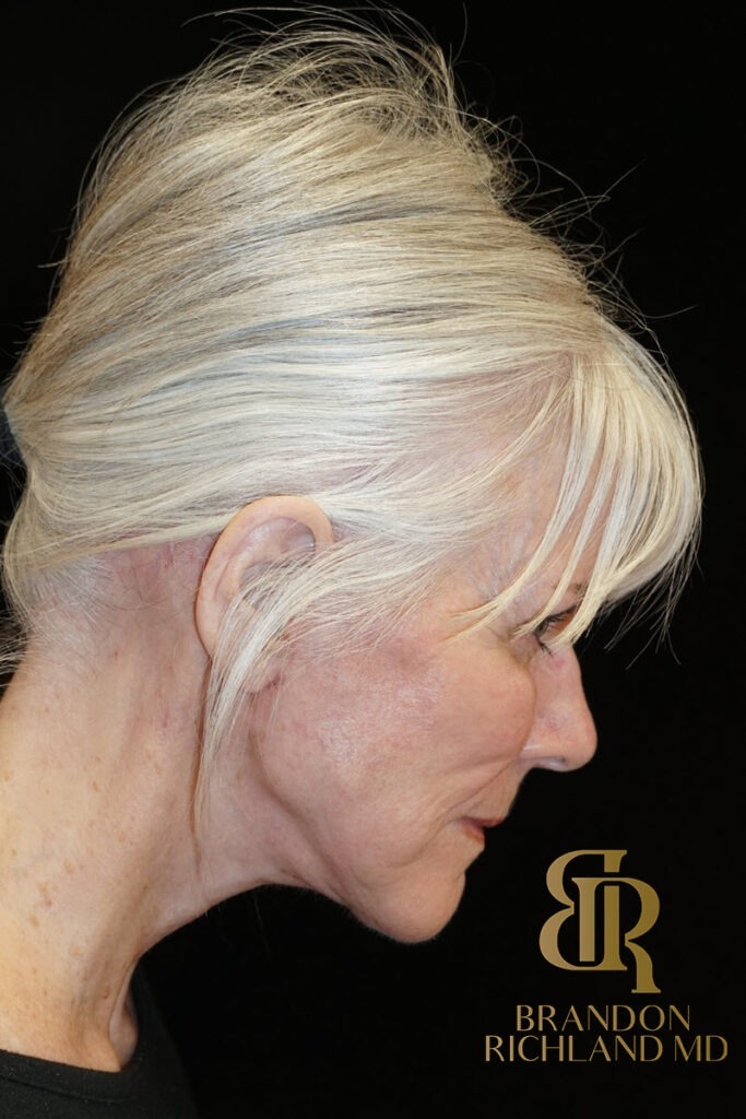 Neck Lift After, Patient 04, view 4 — Dr. Brandon Richland, Newport Beach