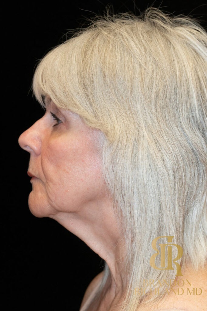 Neck Lift Before, Patient 04, view 6 — Dr. Brandon Richland, Newport Beach