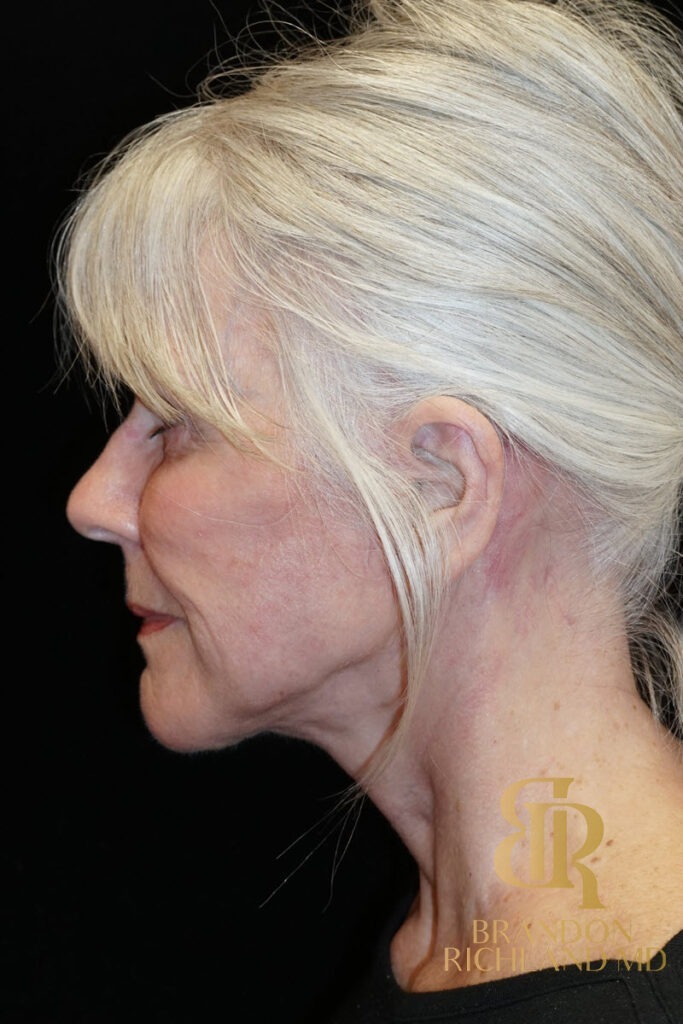 Neck Lift After, Patient 04, view 6 — Dr. Brandon Richland, Newport Beach