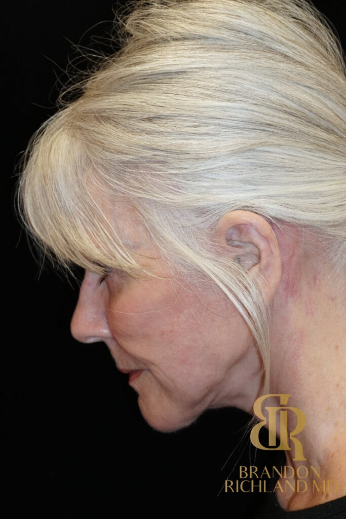 Neck Lift After, Patient 04, view 7 — Dr. Brandon Richland, Newport Beach