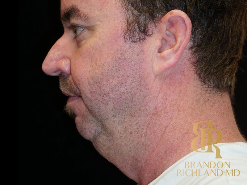 Neck Lift Before, Patient 05, view 2 — Dr. Brandon Richland, Newport Beach