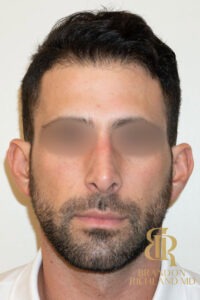 Rhinoplasty before and after, Patient 01 — Dr. Brandon Richland, Newport Beach