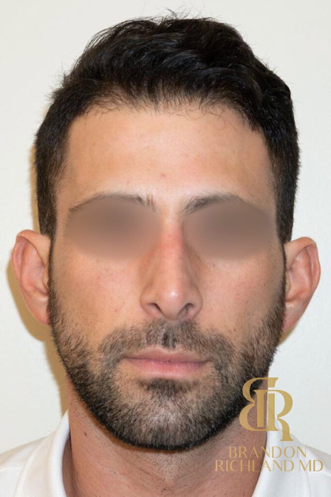 Rhinoplasty Before photo, Patient 01