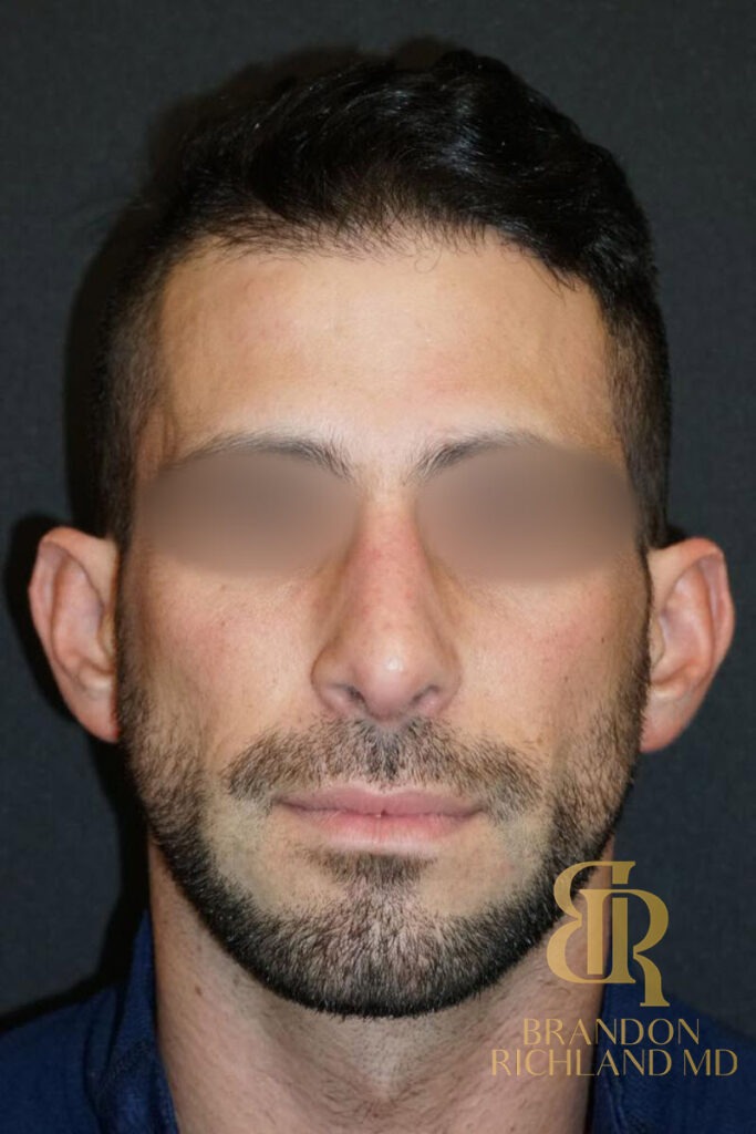 Rhinoplasty After photo, Patient 01