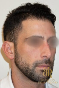 Rhinoplasty before and after, Patient 01 — Dr. Brandon Richland, Newport Beach