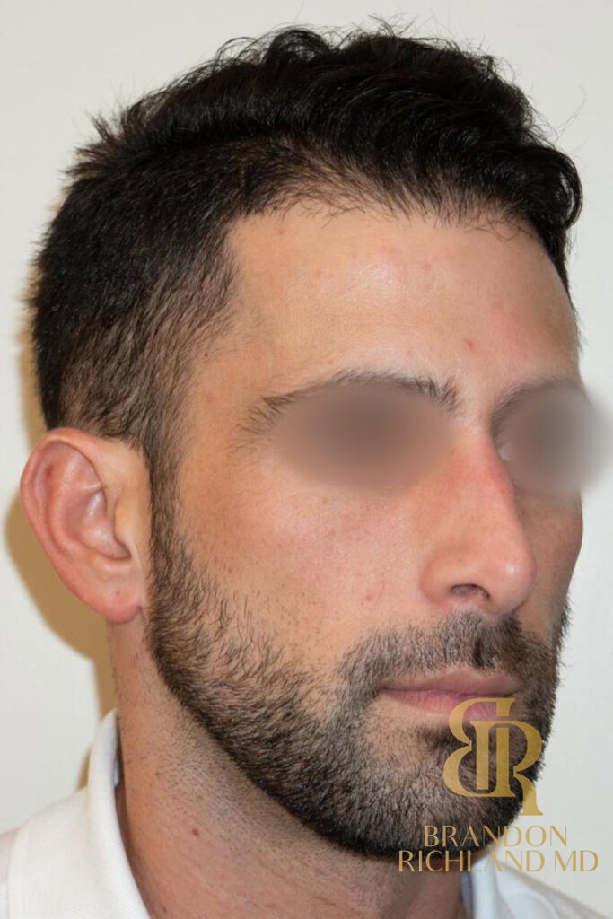 Rhinoplasty Before photo, Patient 01