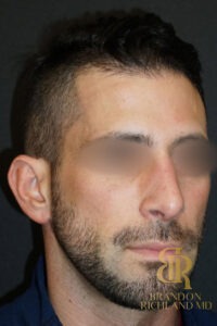 Rhinoplasty before and after, Patient 01 — Dr. Brandon Richland, Newport Beach