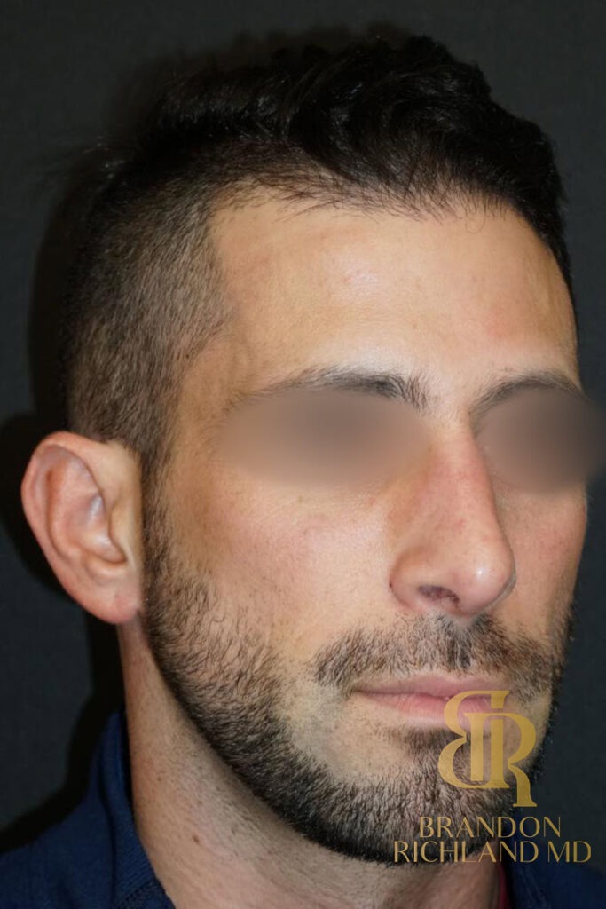Rhinoplasty After photo, Patient 01