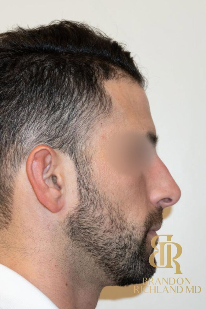Rhinoplasty Before photo, Patient 01