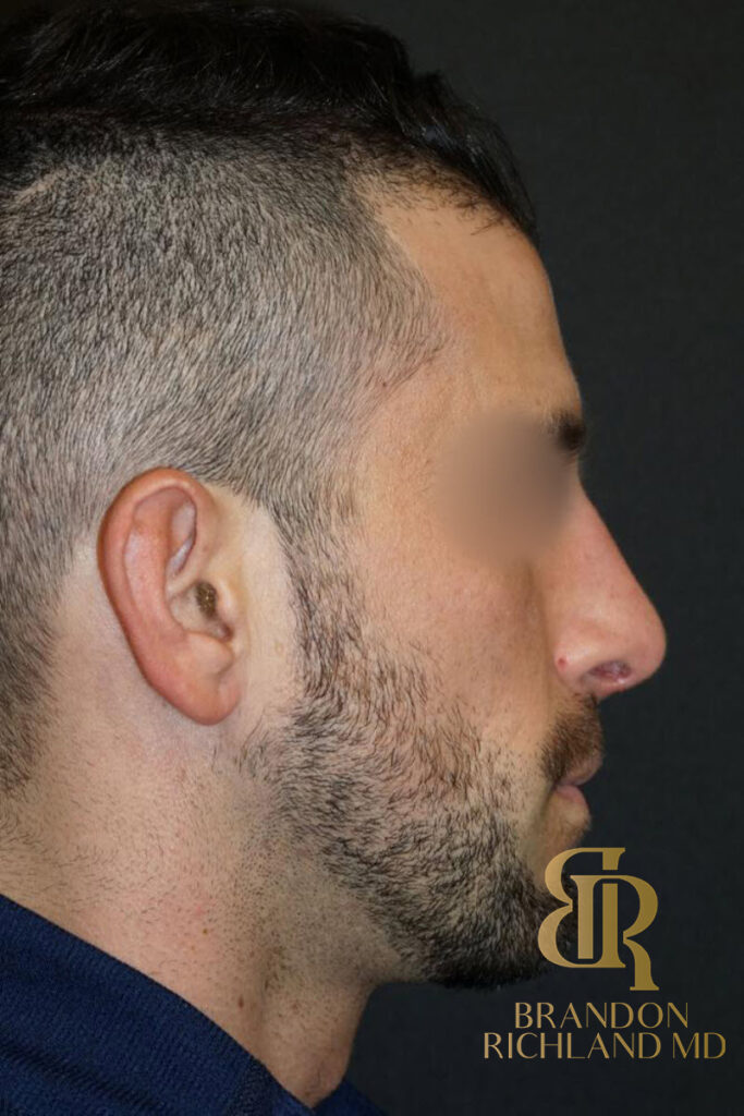 Rhinoplasty After photo, Patient 01