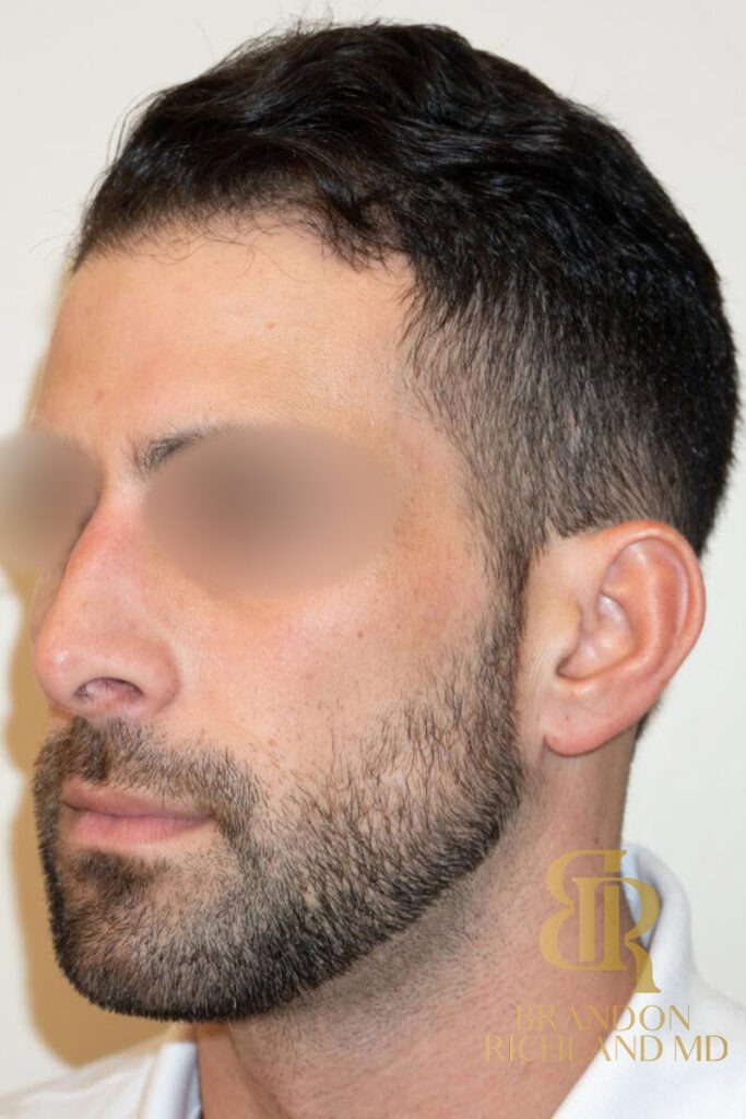Rhinoplasty Before photo, Patient 01