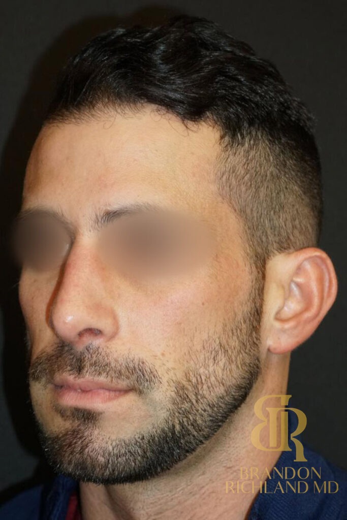 Rhinoplasty After photo, Patient 01