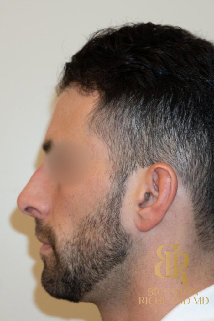 Rhinoplasty Before photo, Patient 01