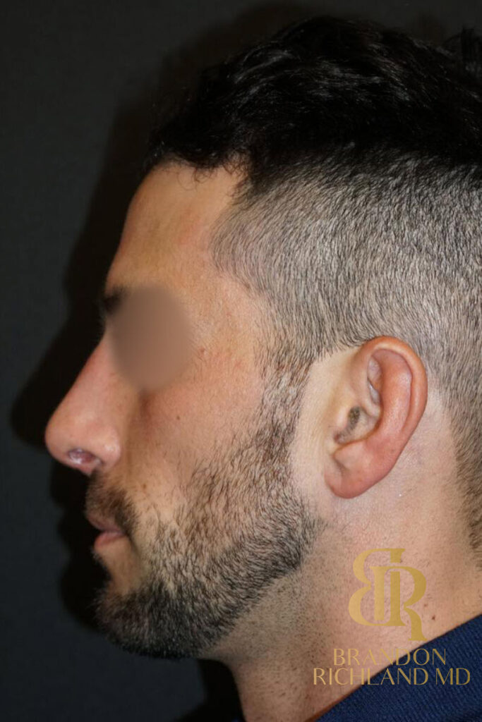 Rhinoplasty After photo, Patient 01