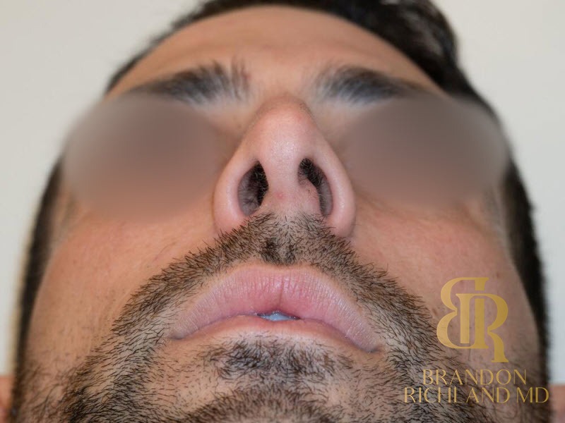 Rhinoplasty Before photo, Patient 01